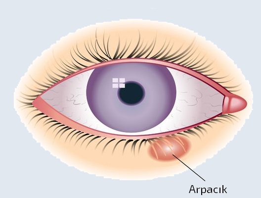Arpacik Sikca Sorulan Sorular Prof Dr Banu Cosar La Goz Sagligi
