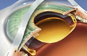 Katarakt Cerrahisinde UV Filtreli Göz İçi Lensler
