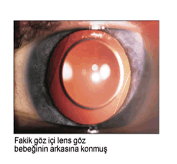 Fakik göz içi lens operasyonu görsel 2