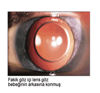 fakik goz ici lens goz ameliyatlari prof dr banu cosar la goz sagligi