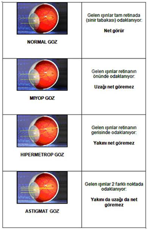 Göz Bozukluğu