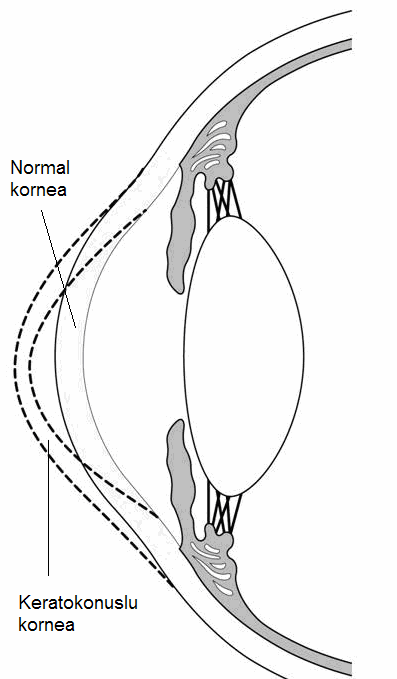 Keratokonusun Belirtileri