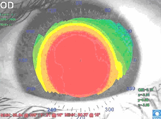 Keratokonus Tanı