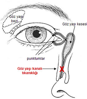 Göz yaşı kanalı tıkanıklığı